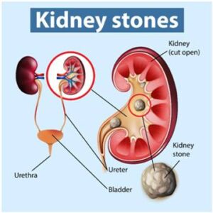 Laparoscopic Surgery for Kidney Stone Removal