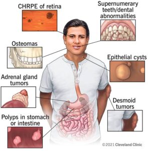 Treatment Of Colon Polyps In Pune- Dr. Samrat Jankar