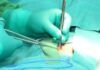 How to Choose the Right Surgeon for Hernia Repair