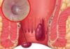 Anal Fissures: What You Need to Know