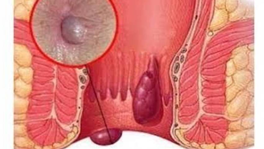 Anal Fissures: What You Need to Know