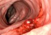 Should I ignore rectal bleeding?