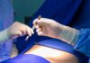 Surgical Options for Crohn’s and Colitis Patient